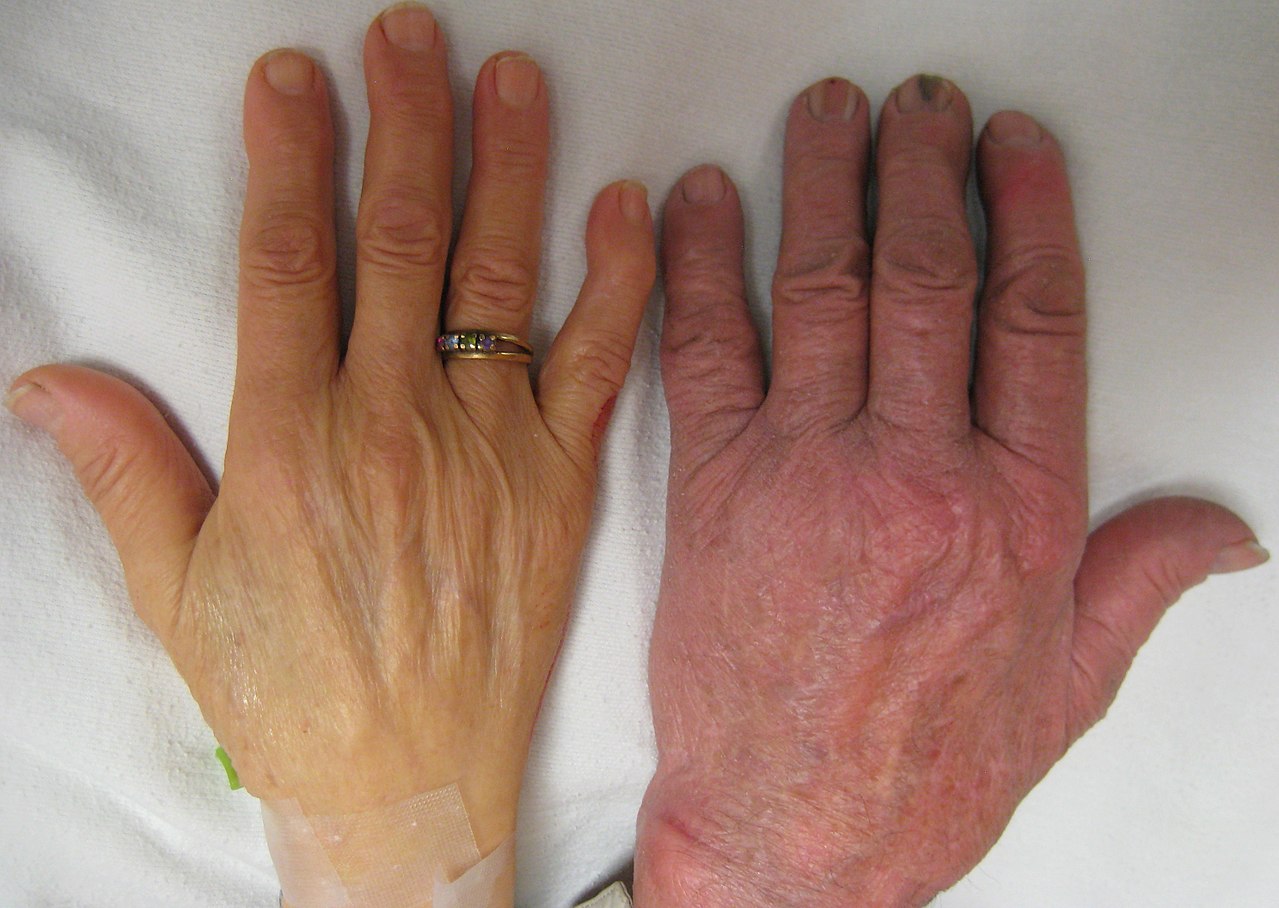 سمت چپ: دست فرد مبتلا به کم خونی شدید. سمت راست: دست فرد بدون کم خونی.