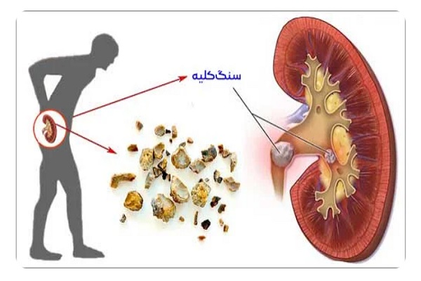 🎥 ویدئو / نشانه های سنگ کلیه